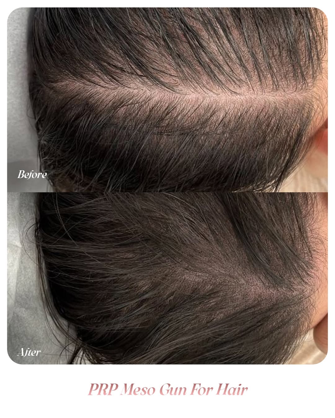 ✨ PRP Meso Gun = stronger, healthier, thicker hair and fuller Volume ✨✨ From thinning to thrivin