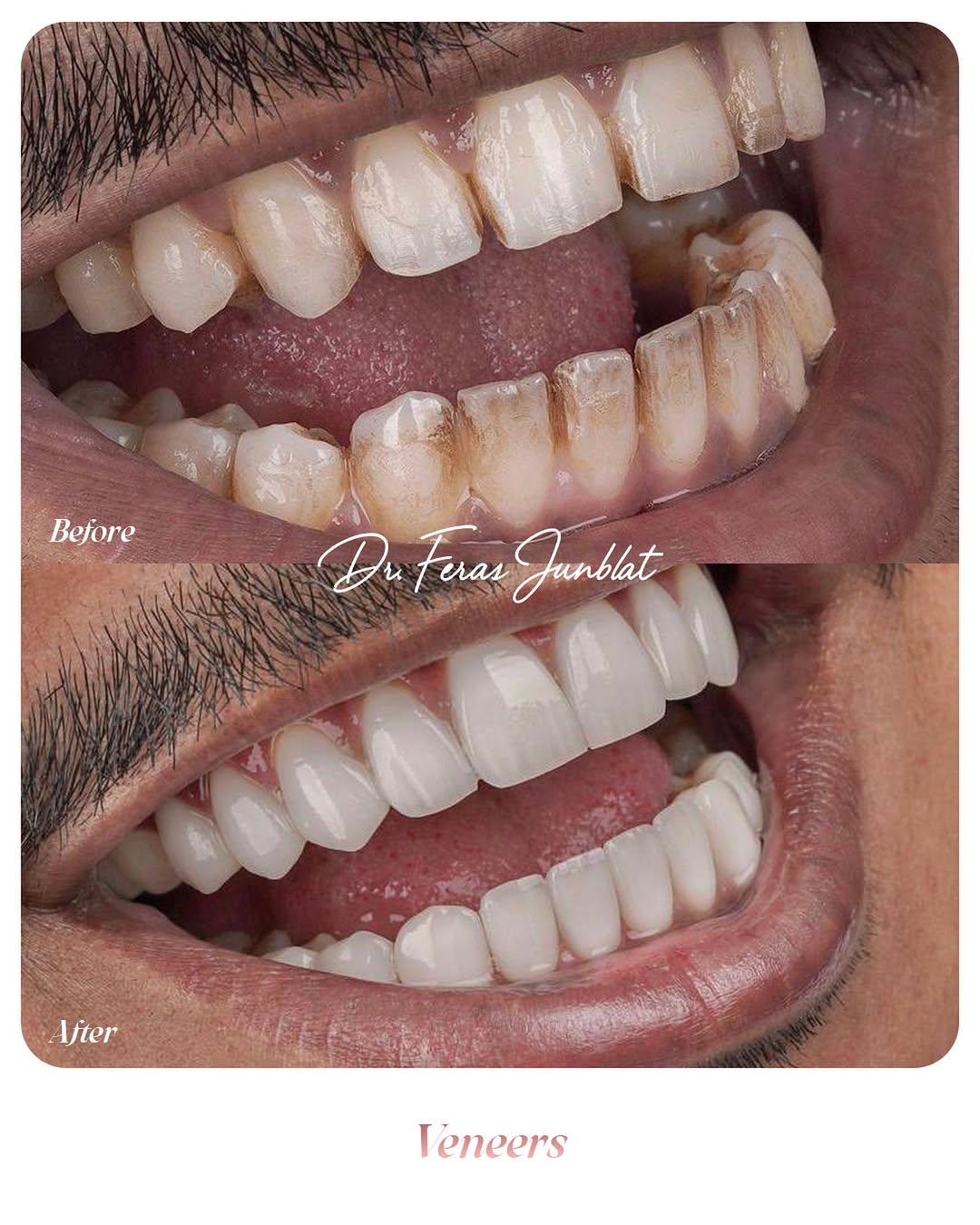 ✨ Transform Your Smile with Veneers by @dr.ferasjomblatt ! ✨Achieve a flawless, natural-looking