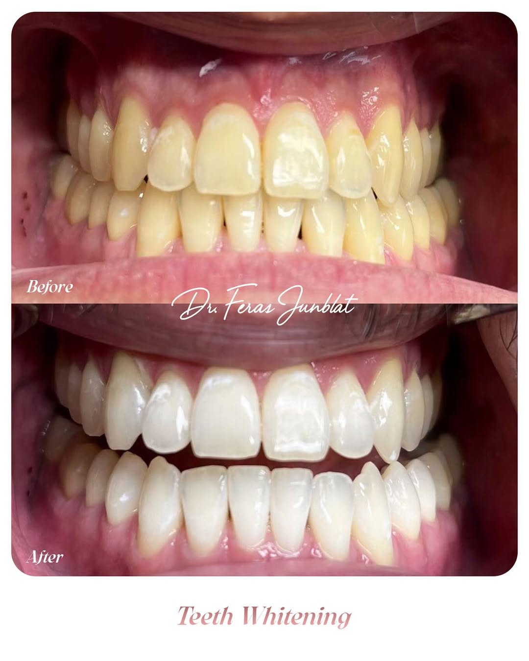 ✨ Your smile deserves the spotlight ✨Reveal a brighter, more confident you with Teeth Whitening