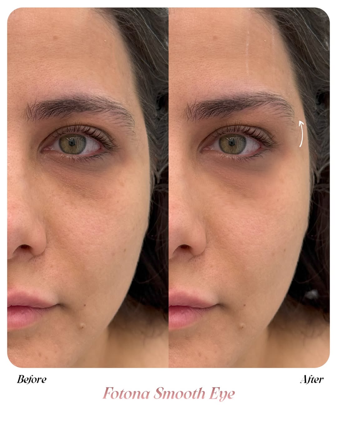 ✨Discover the magic of Fotona SmoothEye✨• Reduces fine lines & wrinkles• Tightens and firms sagg