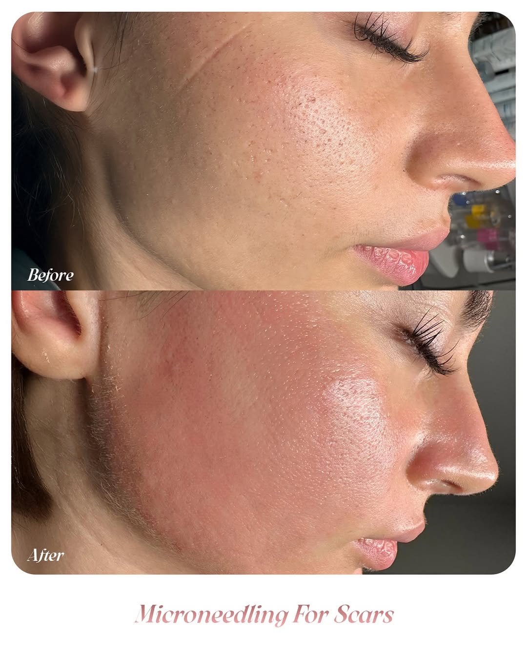 ✨Microneedling = collagen boost ✨~ From scars to smooth ~Micro-needling works beneath the skin t